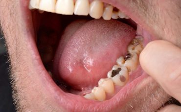 Dream of Rotten Teeth - 15 Types and Their Interpretations