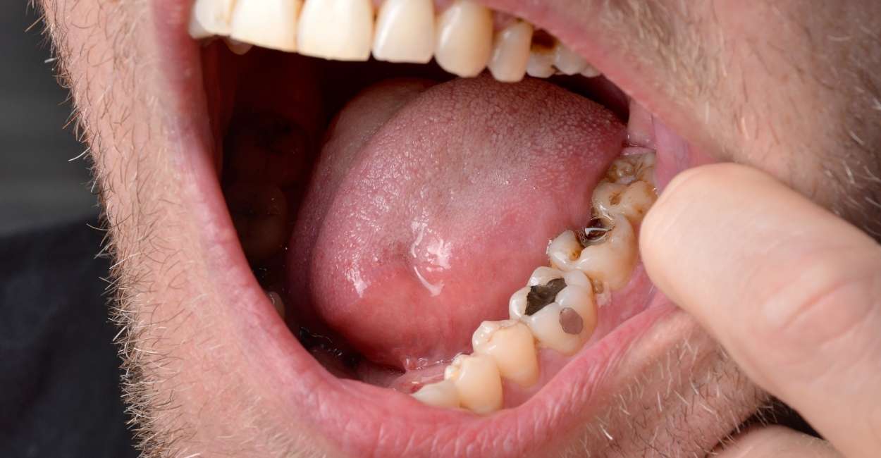 Dream of Rotten Teeth - 15 Types and Their Interpretations