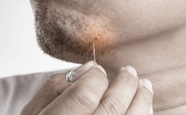 Dream about Ingrown Hair – Does It Represent Your Sexual Desires Symbolically?