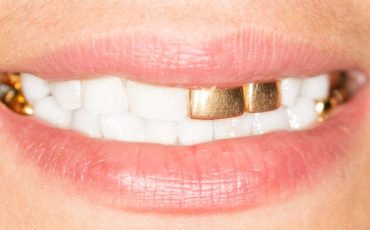 Dream about Gold Teeth – Does It Imply Excessive Concern for Others' Opinions of You?