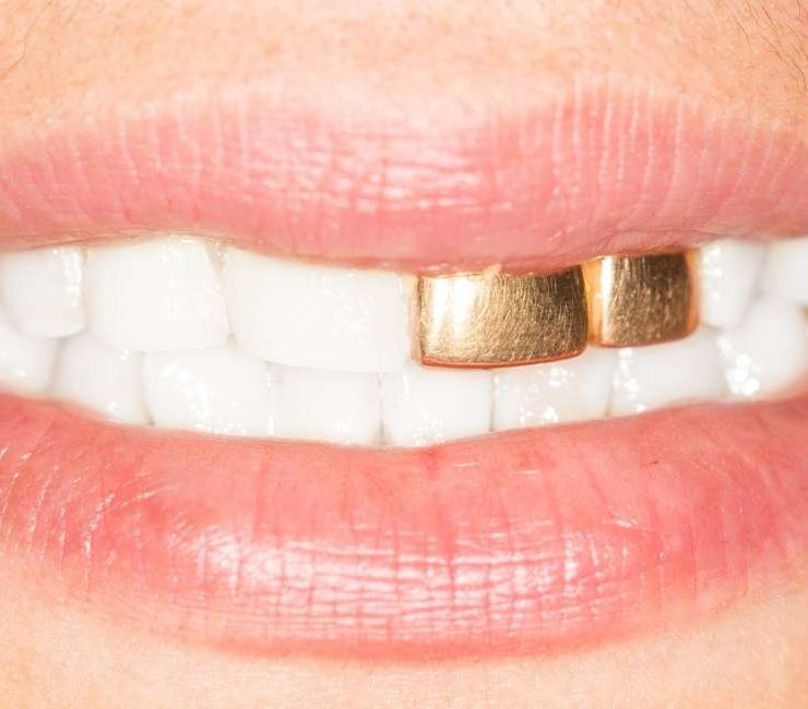 Dreaming of Gold Teeth – 20 Types & Their Interpretations