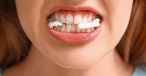 Dream about Gum Sticking to Teeth – Are You Currently Overlooking Problems?