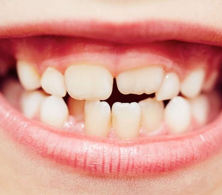 Crumbling Teeth in Dreams – 30 Types & Their Interpretations