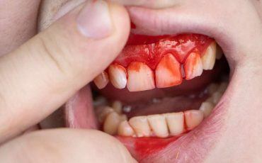 Dream about Teeth Bleeding – Brace Yourself For A Tough Time