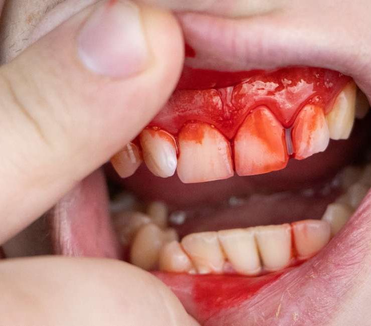 Dream about Teeth Bleeding – 20 Types & Their Interpretations