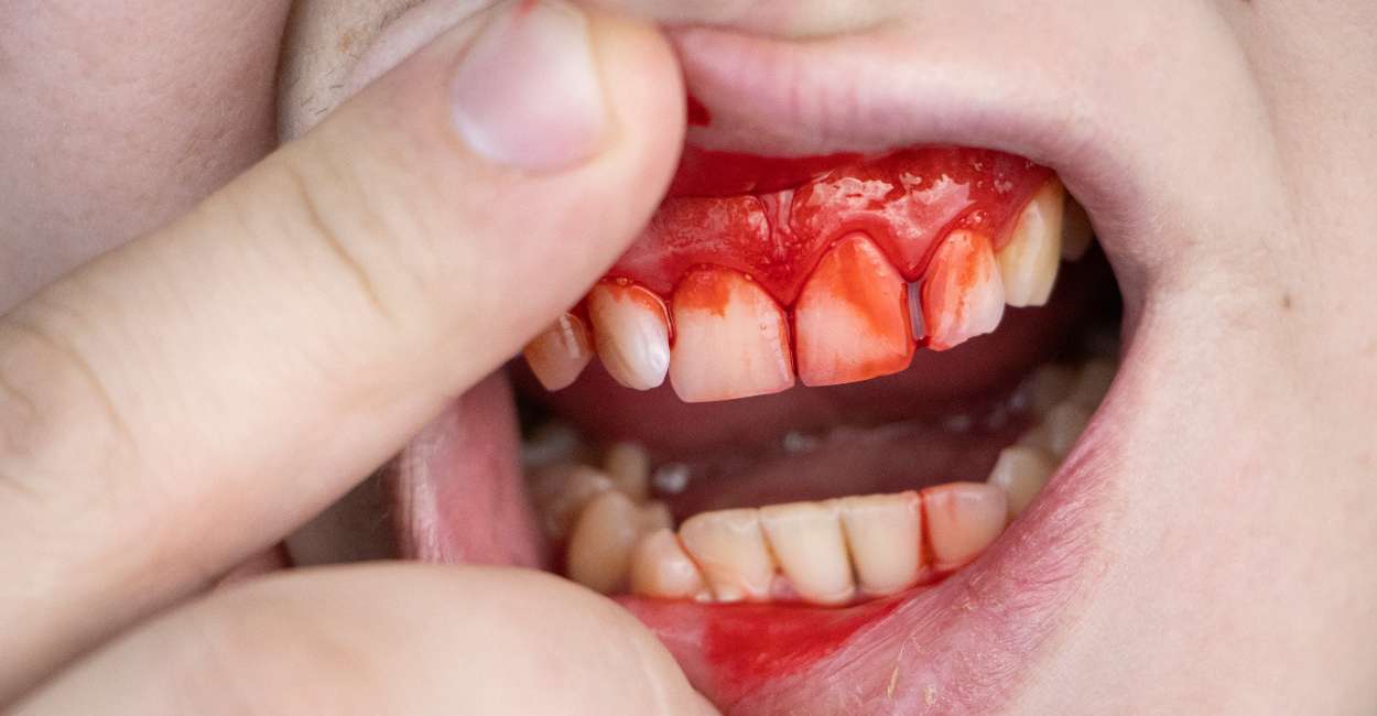 Dream about Teeth Bleeding – Brace Yourself For A Tough Time