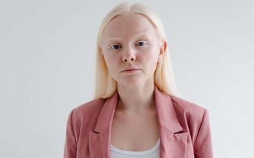 Albino Dream Meaning – Welcome the New Phase in Your Life