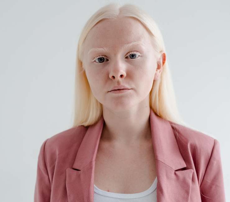 Albino Dream Meaning - 35 Types & Their Interpretations