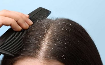 Dream of Dandruff - Is It a Sign of Declining Health