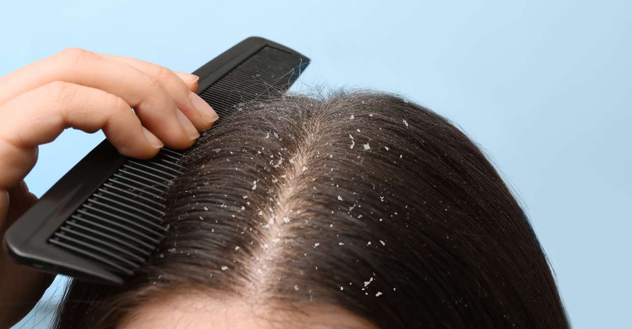 Dream of Dandruff - Is It a Sign of Declining Health